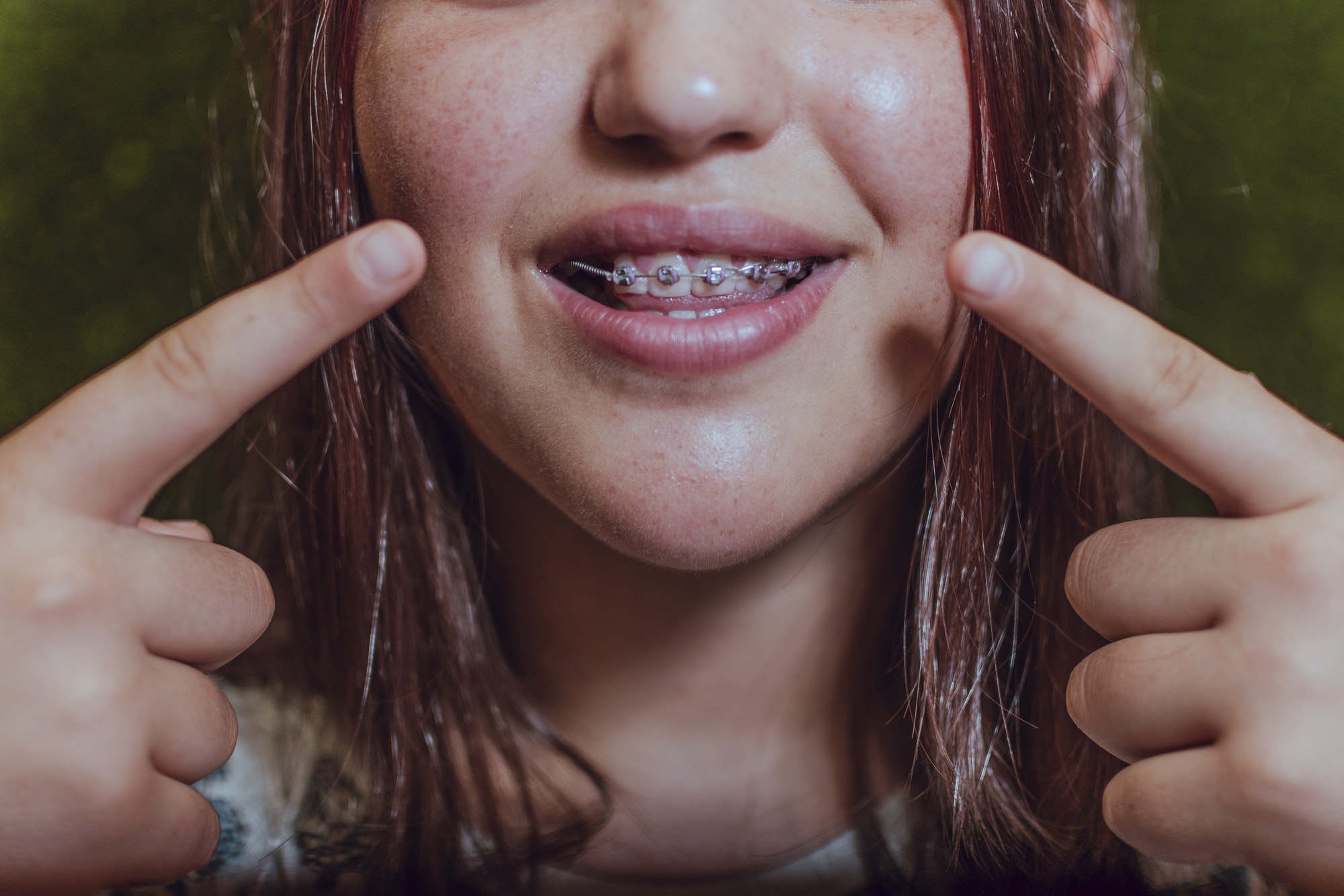 Dentistry concept. Brunette girl pointing at the brackets.