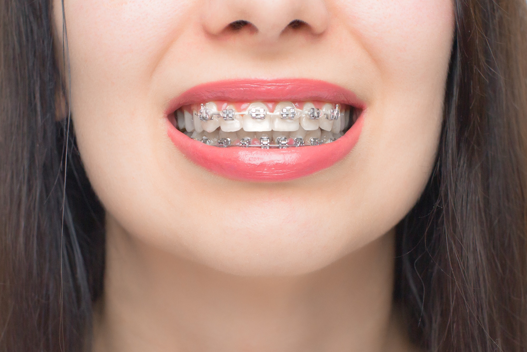 Young woman smile with dental braces. Brackets on the teeth after whitening. Self-ligating brackets