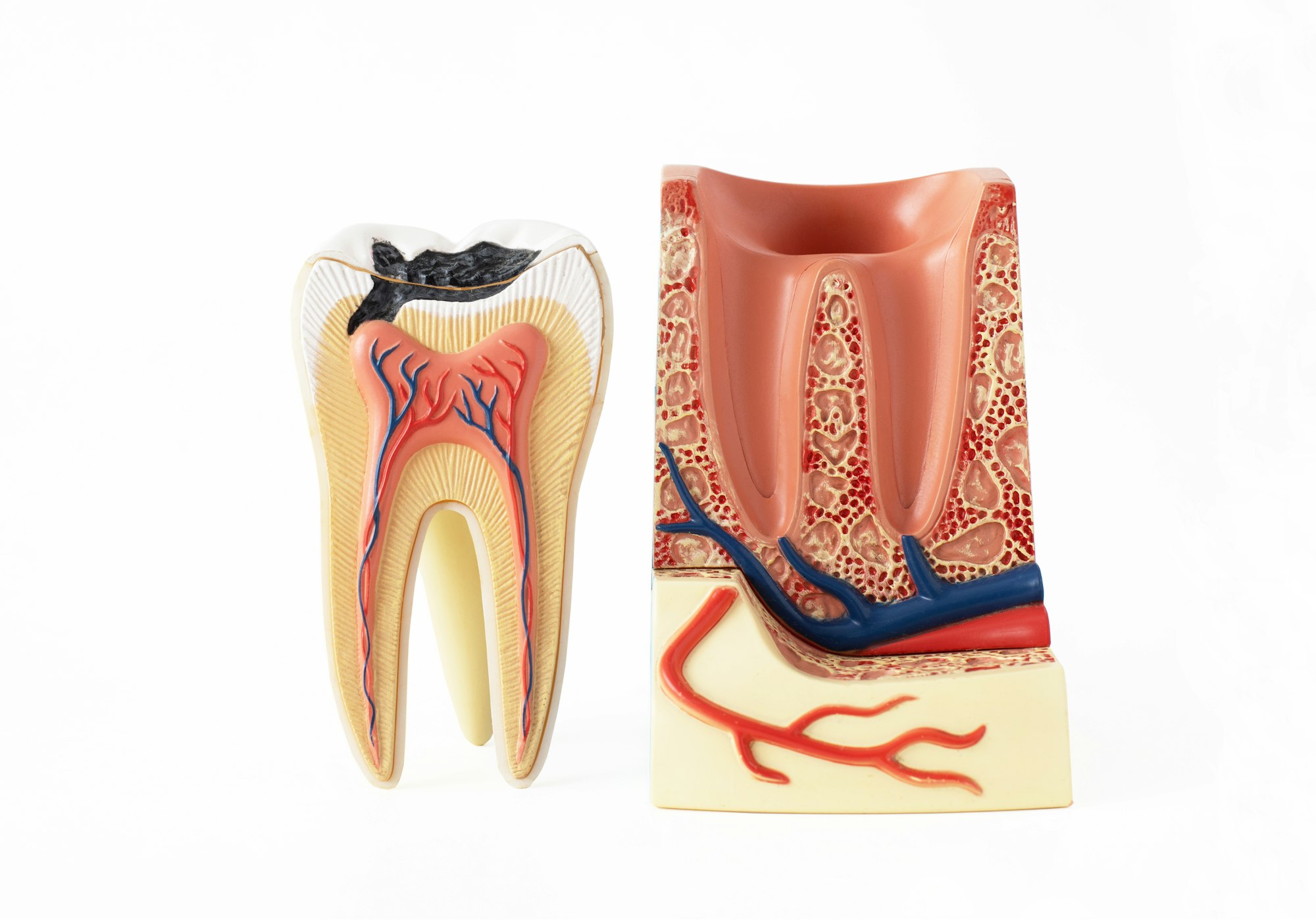Isolated on a white background educational model of a tooth with caries in a section with channels