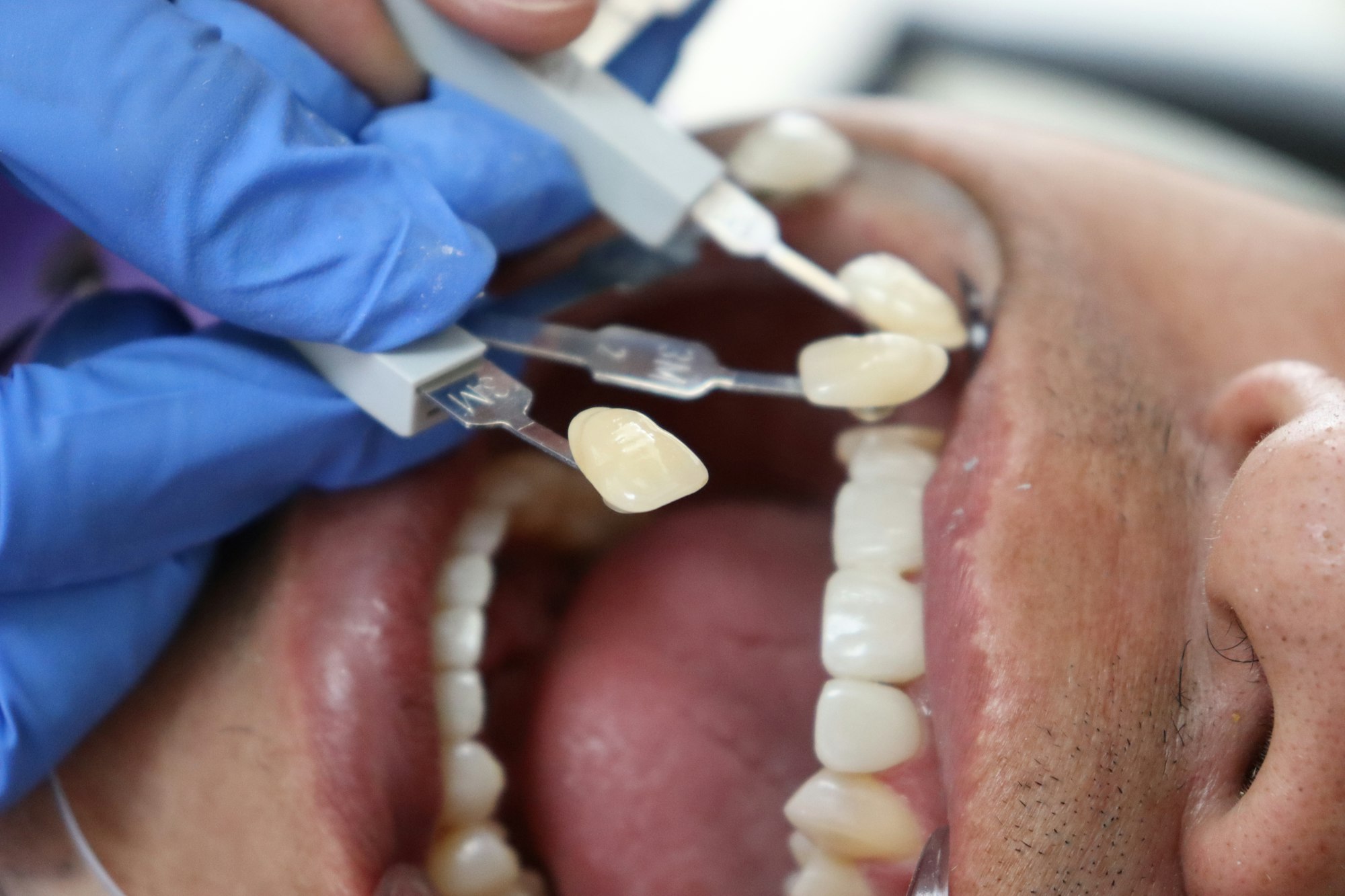 Toma de color de dientes en boca de paciente